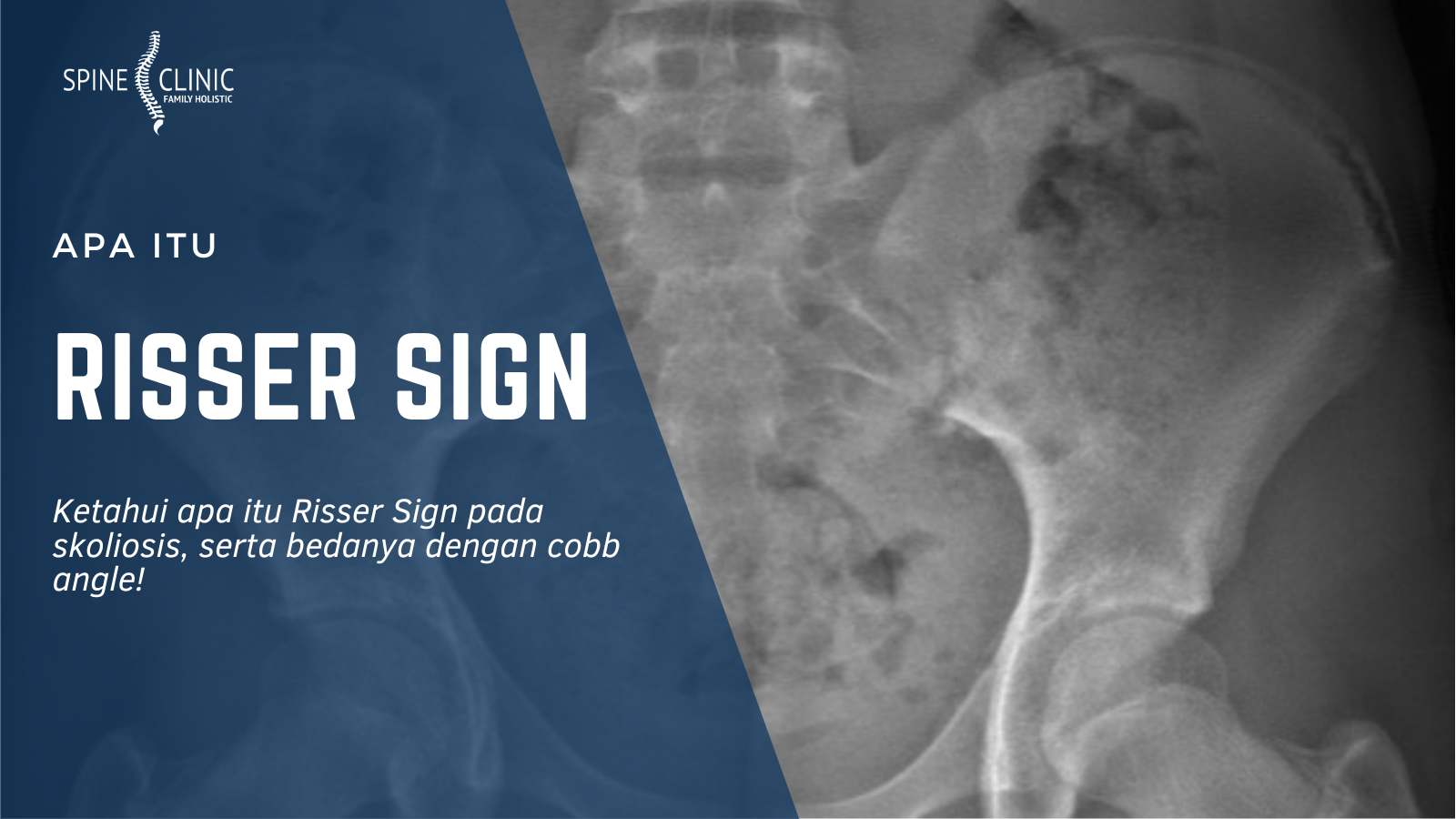apa itu risser sign skoliosis