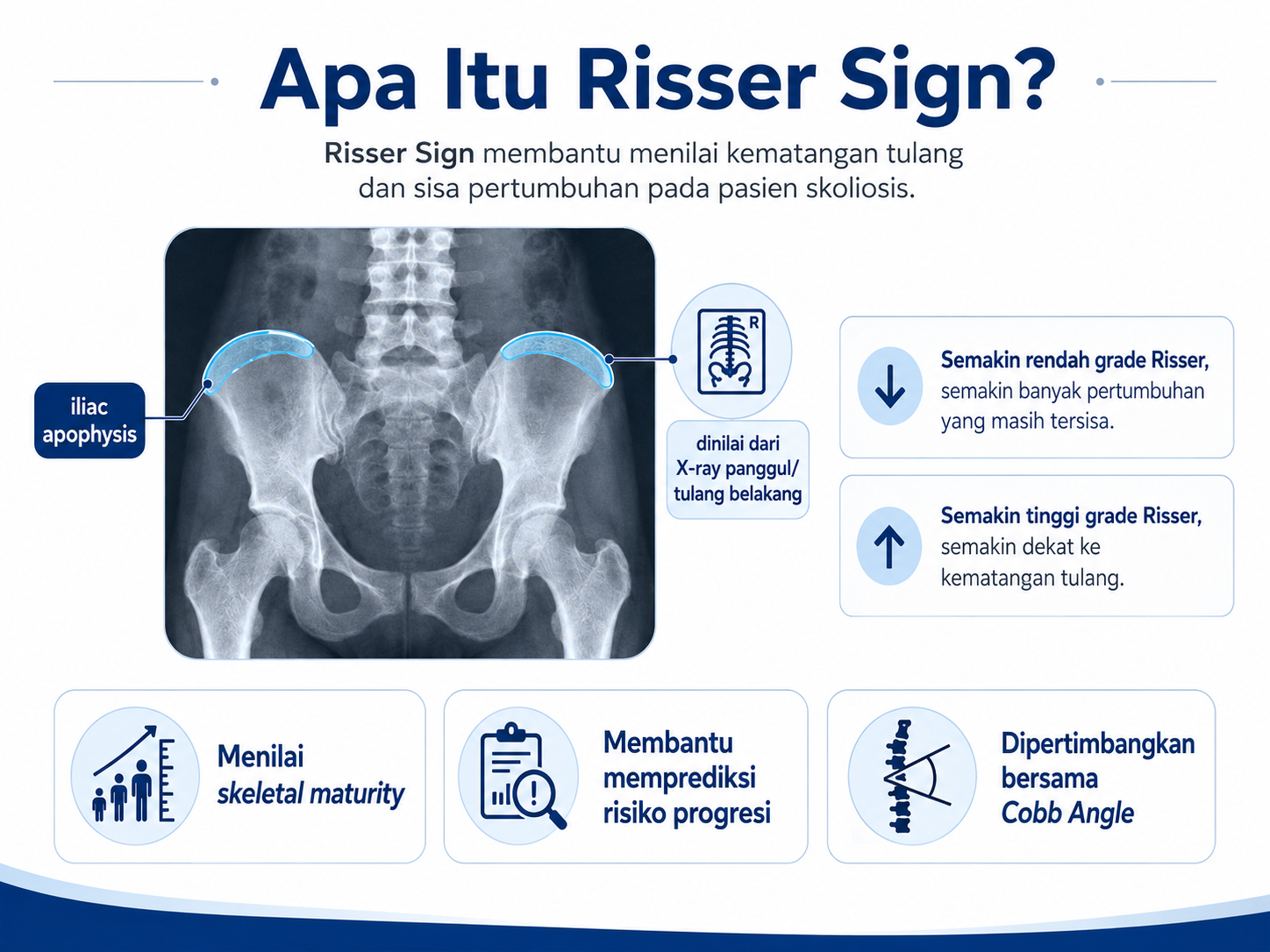 apa itu risser sign