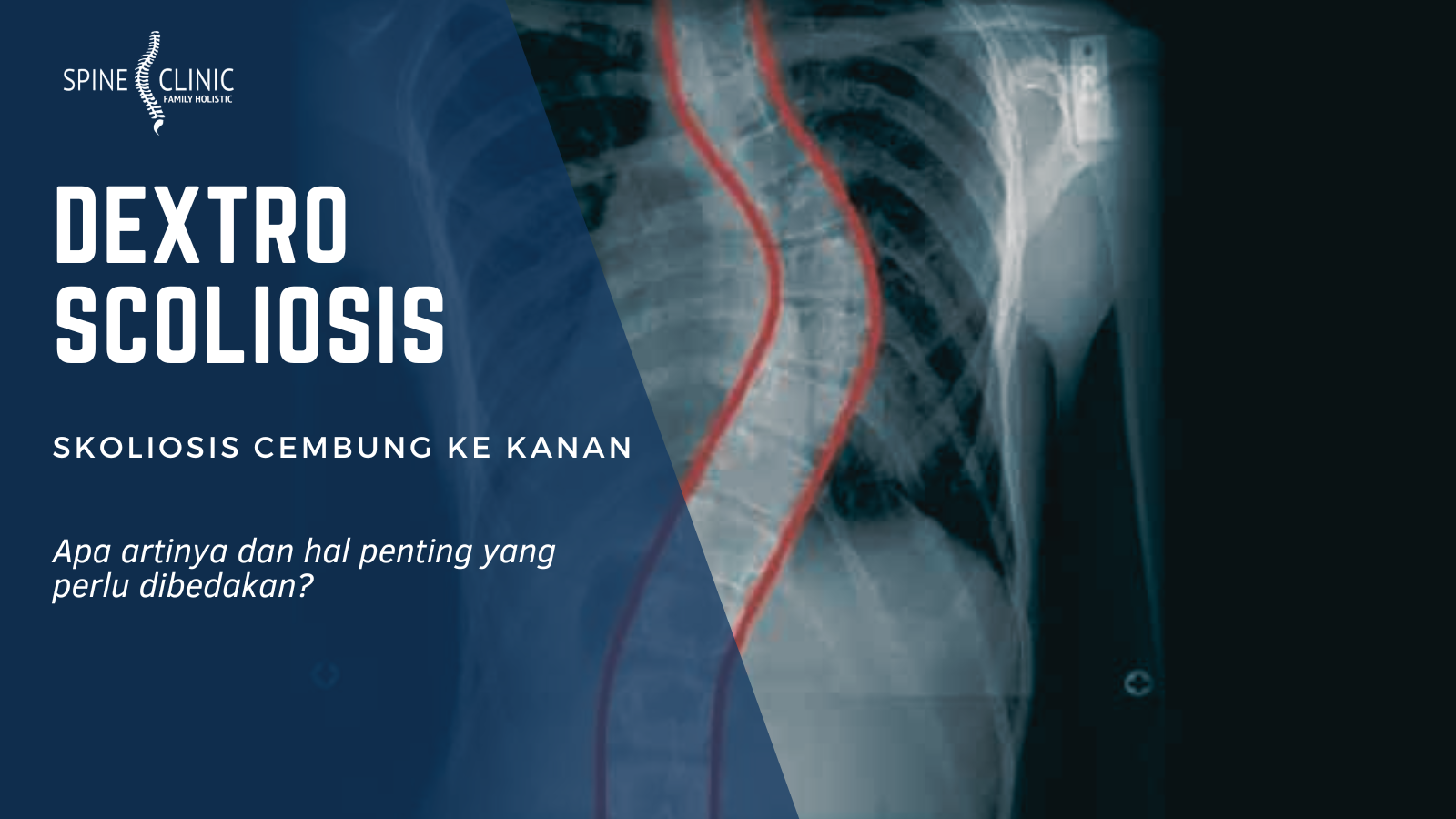 Dextroscoliosis