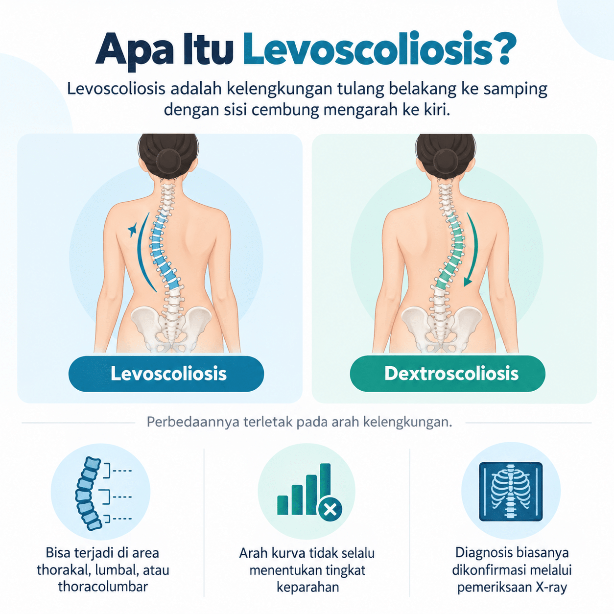 apa itu levoscoliosis