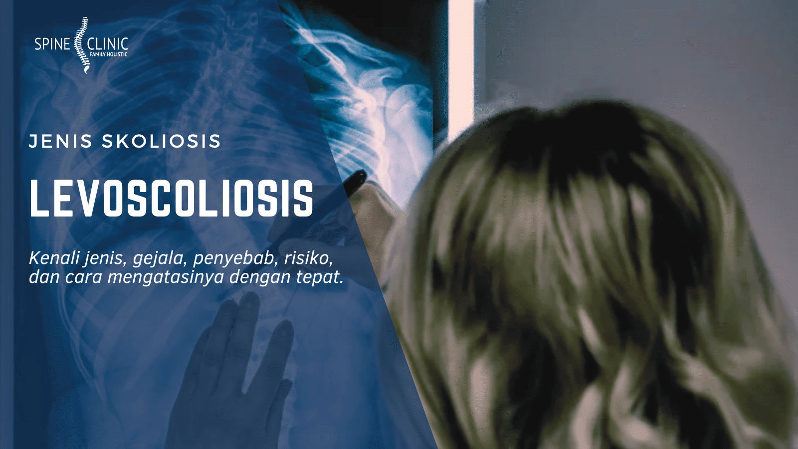 levoscoliosis